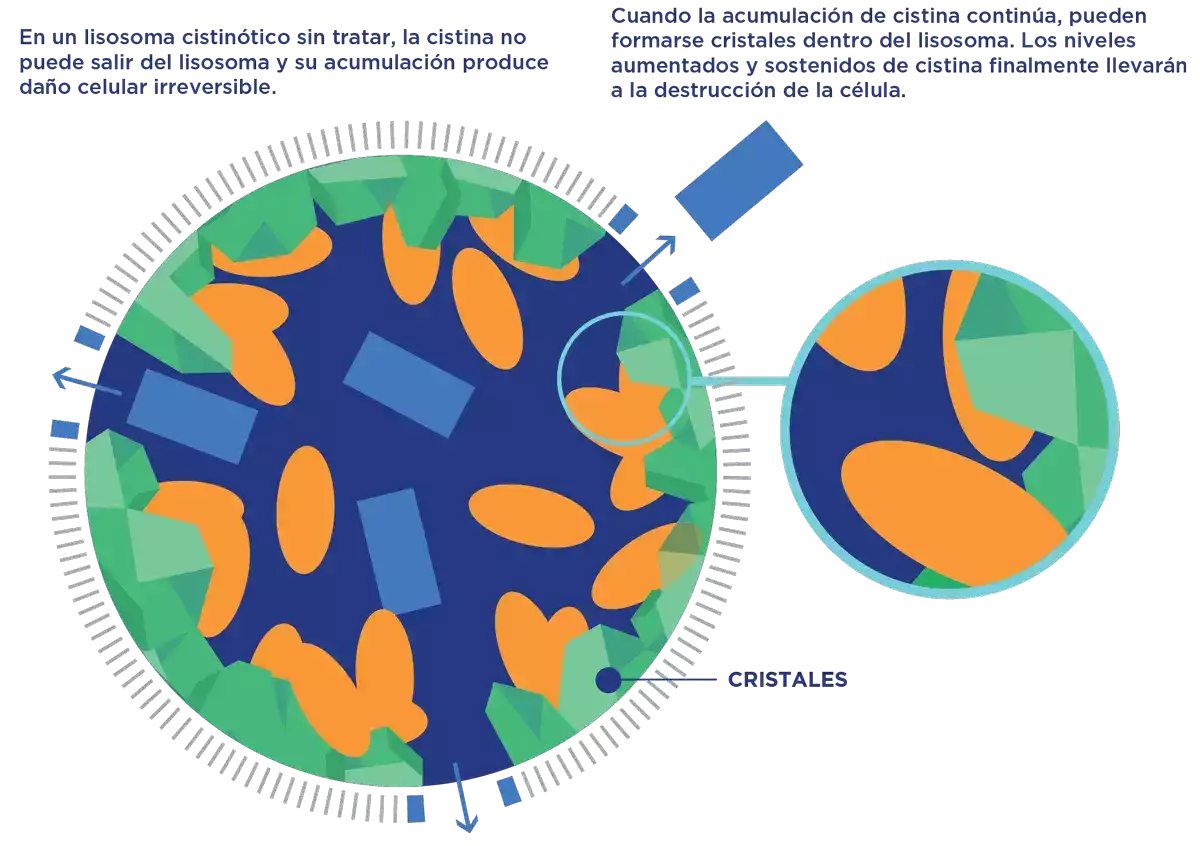Cistinosis cuadro 2